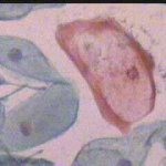 Κοιλοκύτταρο (γιγαντιοκύτταρο - έρπης!)